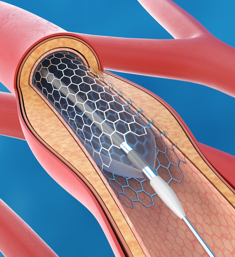 Cardiac Stent for Angioplasty