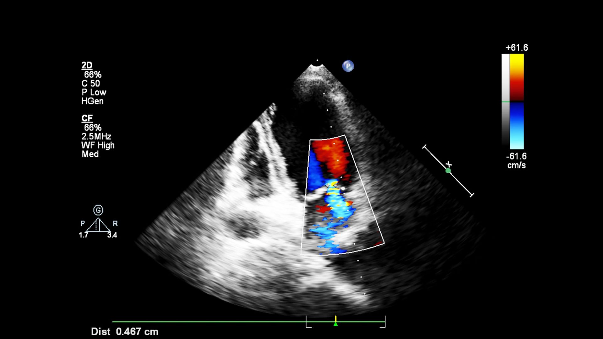 Image of the heart during transesophageal ultrasound with Doppler mode.