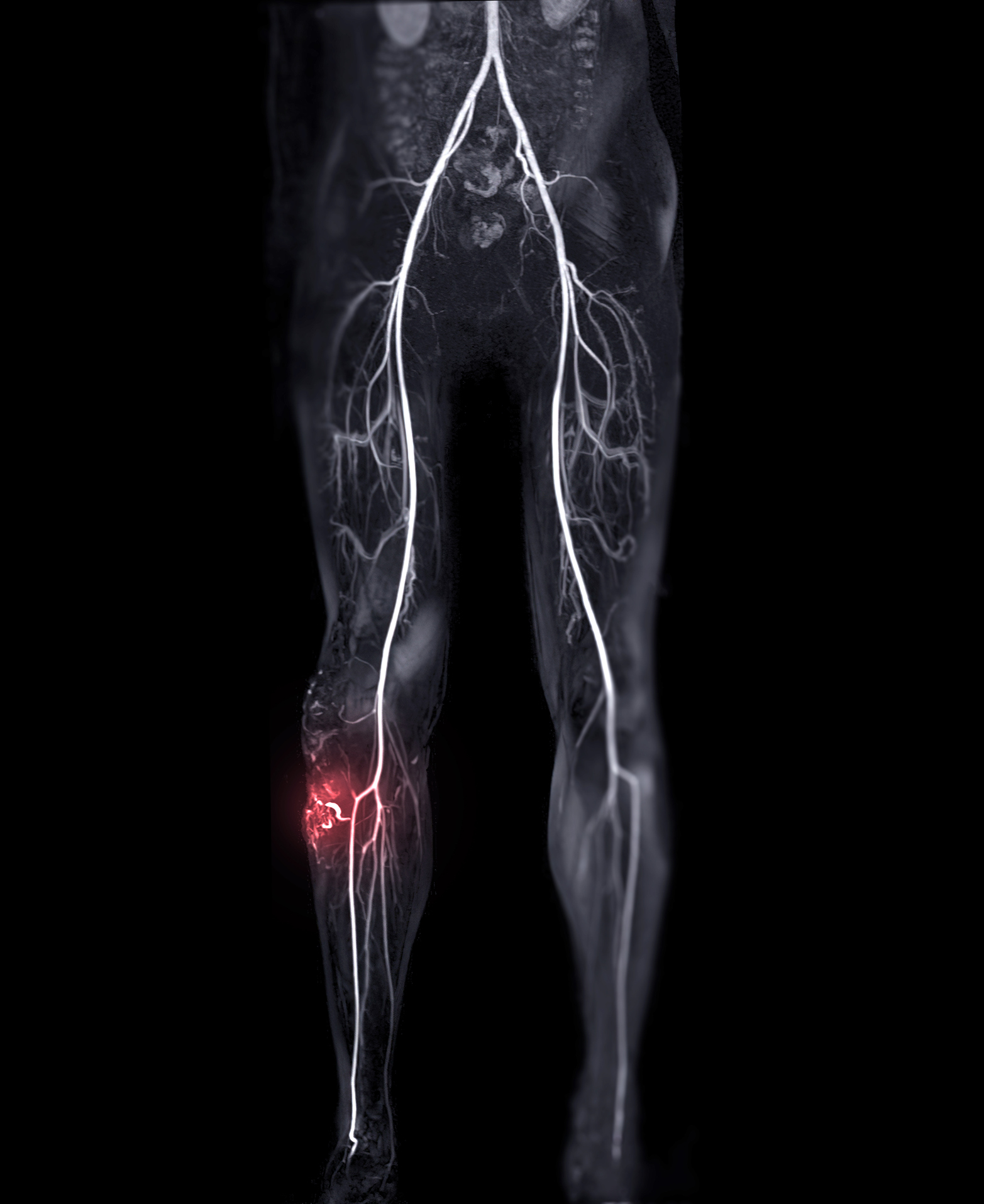 Magnetic resonance angiography of peripheral runoff vessels showing Arteriovenous malformation.