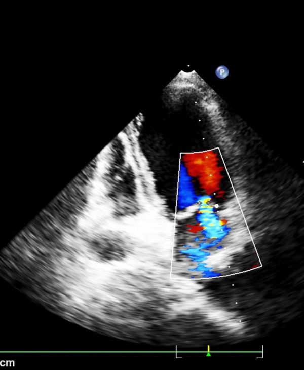 Cardioverter Defibrillator Transesophageal Echo (TEE)