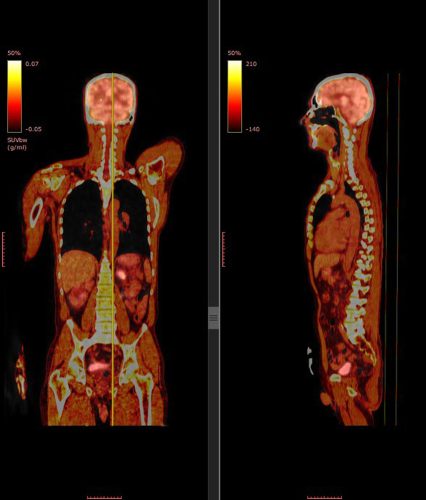 PET Scan